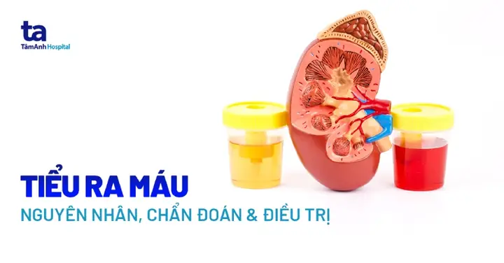 Đi Tiểu Ra Máu: Nguyên Nhân, Cách Xử Lý Và Chế Độ Dinh Dưỡng Hỗ Trợ